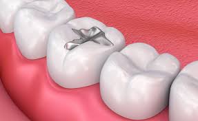 Understanding the Different Types of Dental Fillings: Which is Best for You? silver fillings 
