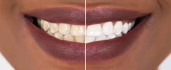 https://queensdrivedental.co.uk/blog/the-ultimate-faq-on-teeth-whitening-what-you-need-to-know-before-brightening-your-smile/#:~:text=Teeth%20whitening%20is%20generally%20safe,disease%20or%20severely%20worn%20enamel.