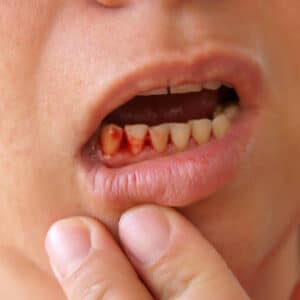bleeding gums Why Your Gums Bleed When You Brush, And What To Do About It.
