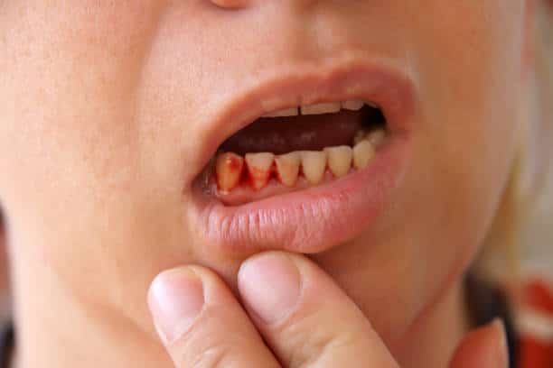 bleeding gums Why Your Gums Bleed When You Brush, And What To Do About It.