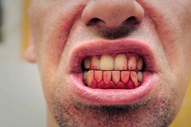 Why Your Gums Bleed When You Brush, And What To Do About It.