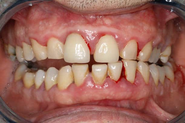 Diabetes and Dental Health: The Connection Most People Miss