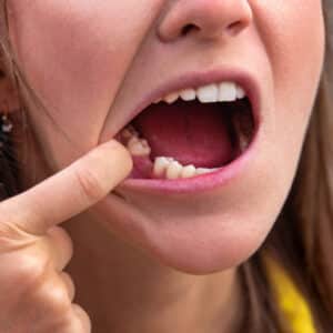 What Happens If You Ignore a Missing Tooth? What Happens If You Ignore a Missing Tooth?