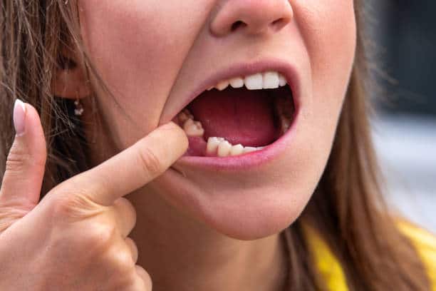 What Happens If You Ignore a Missing Tooth? What Happens If You Ignore a Missing Tooth?