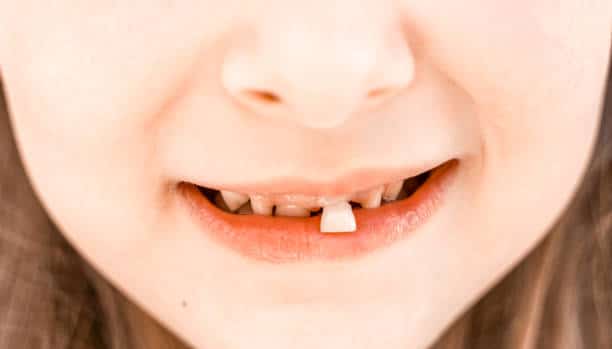 What Happens If You Ignore a Missing Tooth?