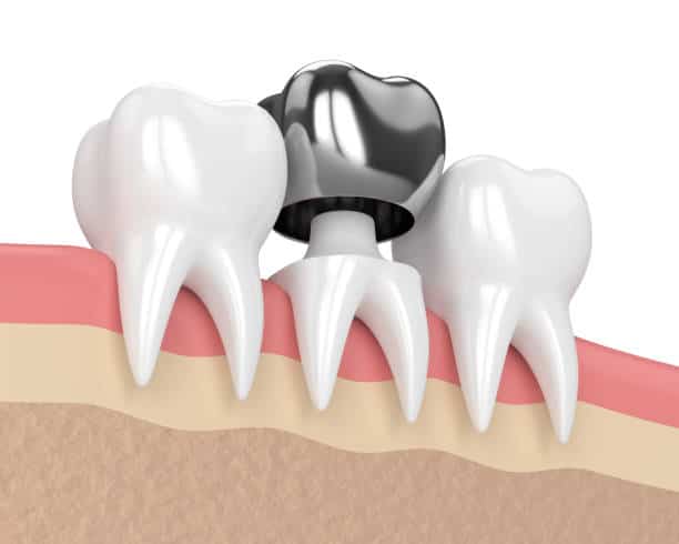 Frequently Asked Questions About Dental Crowns