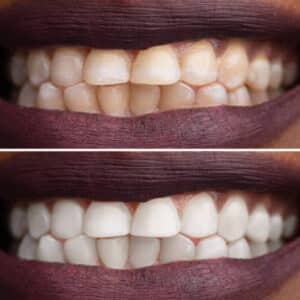 Teeth Whitening: What Works, What Doesn't, and What to Expect Teeth Whitening: What Works, What Doesn't, and What to Expect