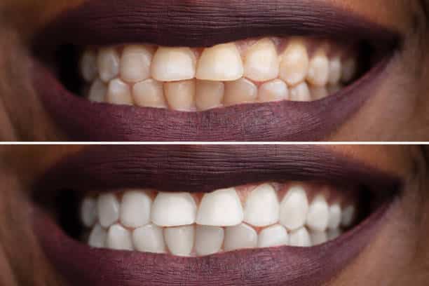 Teeth Whitening: What Works, What Doesn't, and What to Expect Teeth Whitening: What Works, What Doesn't, and What to Expect